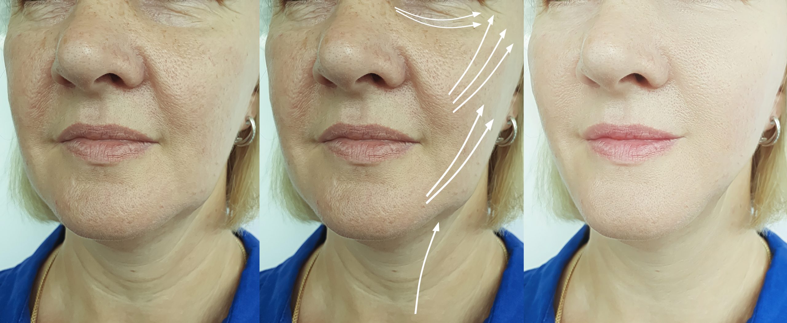 elderly woman face wrinkles before and after treatment arrow